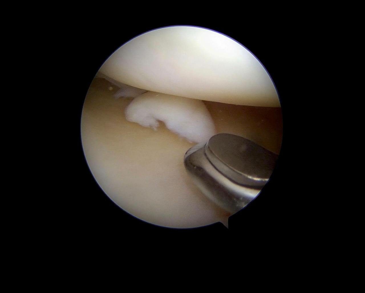 Meniscus surgery and knee arthroscopy in Bangalore